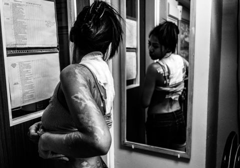 Shirley examines her scars. "When I see the girls, I talk to them, I absorb all their emotions and I can't really believe that some people can do that to other human beings," says Bacani. <br />