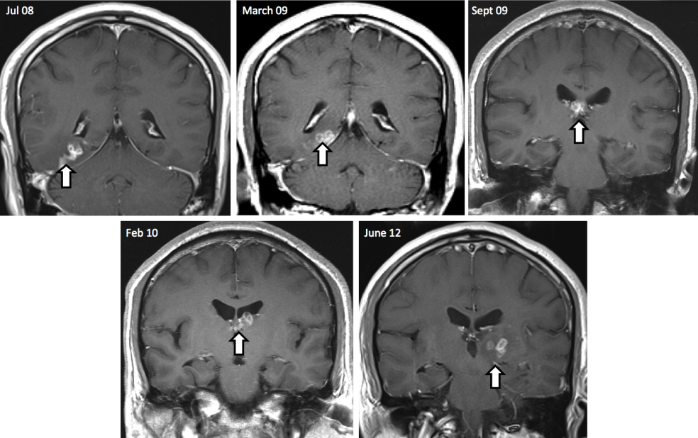 After four years, the British patient returned to hospital in pain to find his brain lesion had migrated to a new region of the brain resulting in new symptoms, including seizures. His MRI scans show the tapeworm's burrowed migration through the brain over four years.