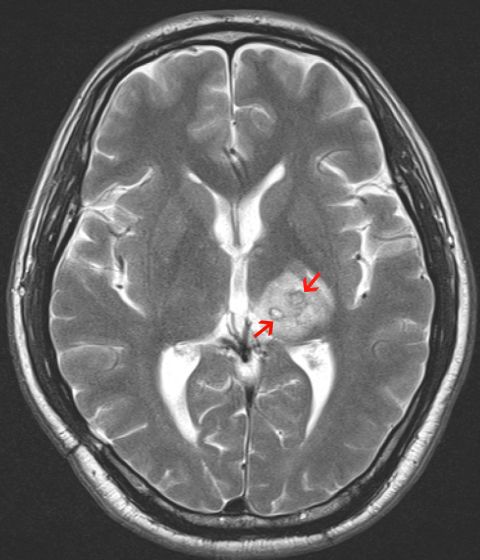 In 2013 a British man of Chinese ethnicity was diagnosed with a tapeworm, <em>Spirometra erinaceieuropaei,</em> inside his brain. The 50-year old first experienced headaches four years earlier and was treated for tuberculosis. The arrows point to the mass created by the worm in his brain.