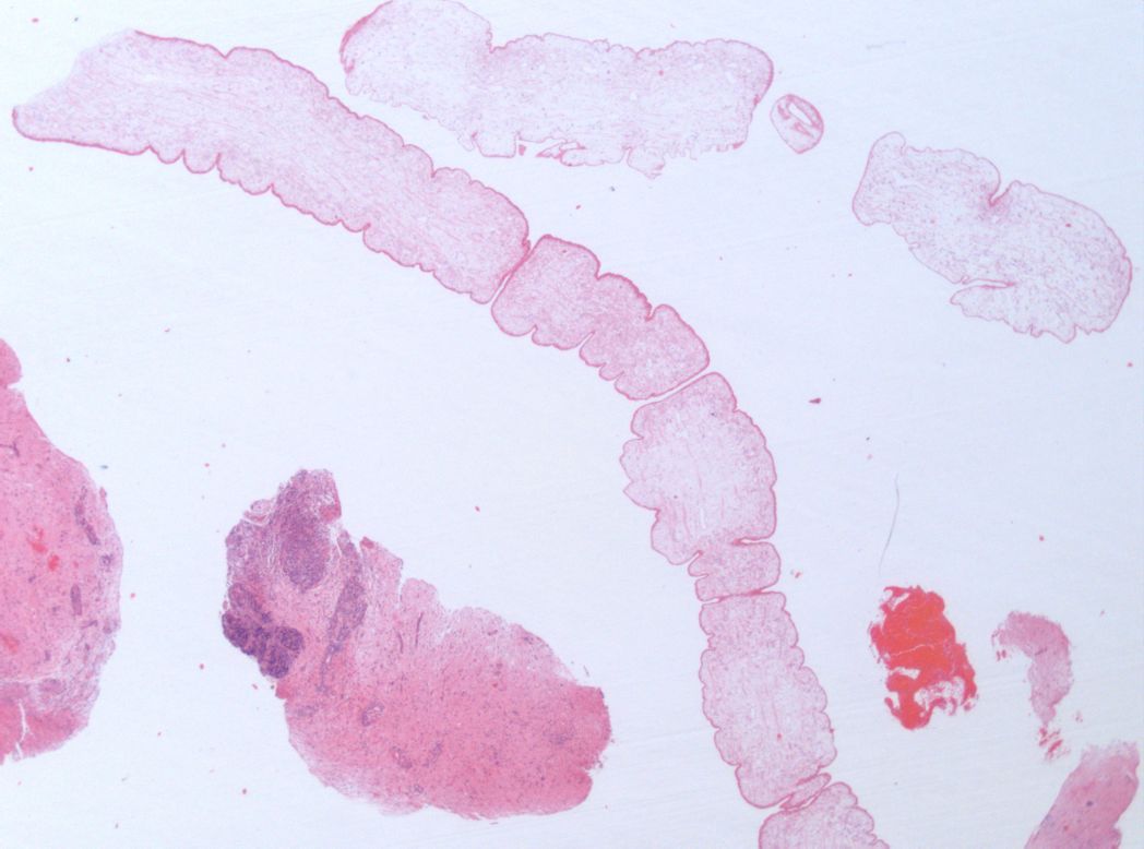 This was the first occurrence of Spirometra erinaceieuropaei in the UK but the infection is more common in China, South Korea, Japan and Thailand. This microscope image shows the worm (center) on a slide after being removed from the patient.