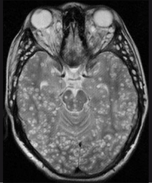 ... but infection with the worms' juvenile (larval) form has worse consequences as the younger worms can migrate to other parts of the body. If they enter the nervous system the worms can form cysts in the brain, which have severe consequences, including epilepsy. In the radiology image above, the cysts are identified as white lumps within the brain.