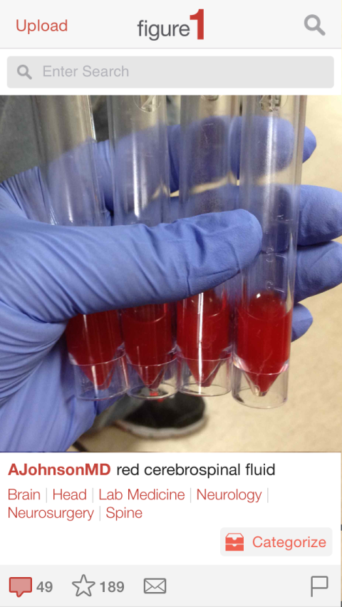 Images of test results, symptoms, X-rays and scans can be posted for consultation from a global pool of experts as well as to train others using the app. Here, a photo of red cerebrospinal fluid is uploaded. Blood in the fluid may be a sign of bleeding or spinal cord obstruction.