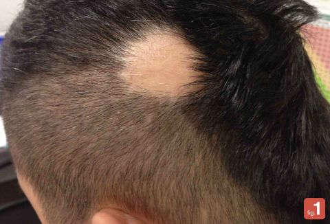 An image uploaded of a patient with alopecia areata, an autoimmune skin disease resulting in the loss of hair on the scalp and elsewhere on the body. The angle of the photo ensured the patient remained anonymous. The app also requires users to obtain permission from patients before posting.