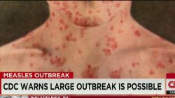 lead dnt tapper measles outbreak_00021812.jpg