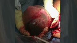 pkg baby born in amniotic sac_00012219.jpg