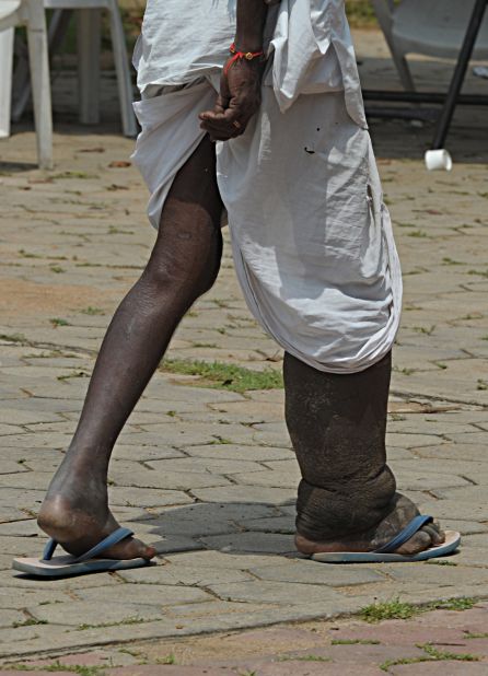 The majority of infections remain asymptomatic but 40 million people worldwide have developed clinical signs of the diseases, such as lymphoedema, causing fluid retention and the characteristic swelling of the legs and feet to enormous proportions. The country with the greatest number at risk of infection is India. There is no treatment or vaccine.