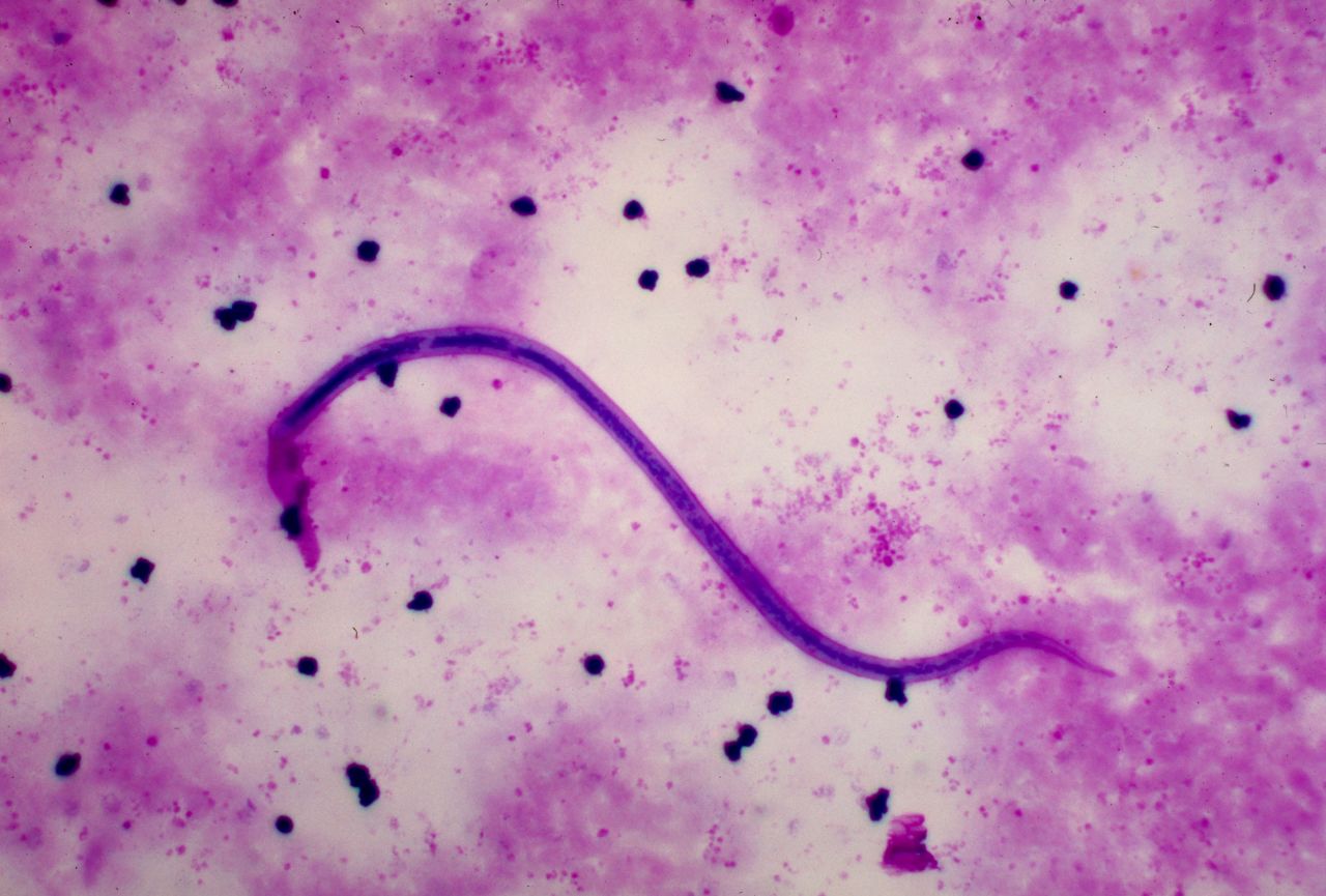 The majority of cases are caused by the parasitic worm Wuchereria bancrofti -- responsible for 90% of cases -- and is called lymphatic filariasis.