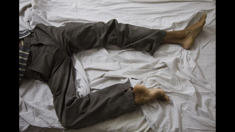 Dharmender lies on a bed in St. Stephen's Hospital a few days before his surgery. Even though his village was poor, his family took good care of him, del Estal said.