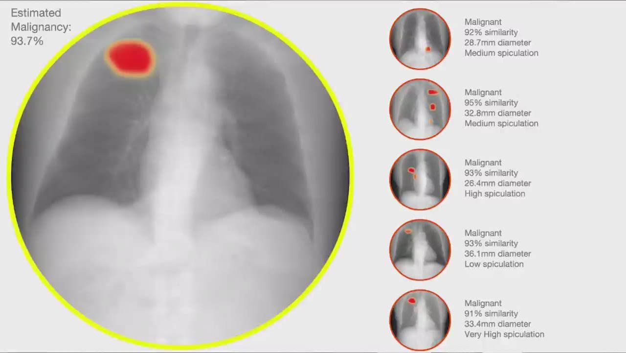 cnnee crane us robot radiologist_00014714.jpg