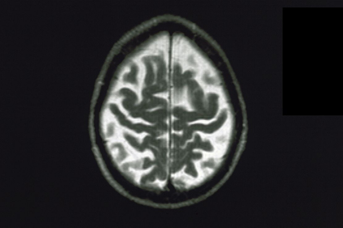 A brain affected by Alzheimer's Disease.