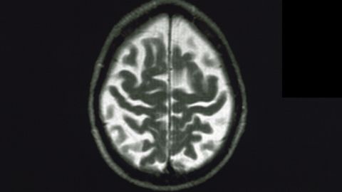A brain affected by Alzheimer's Disease.
