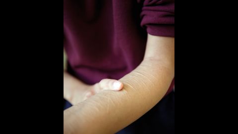 B.E., 17, shows marks on her arms. She told Ross that she and her sister were sexually assaulted by her father. "I haven't cut in years," she said.