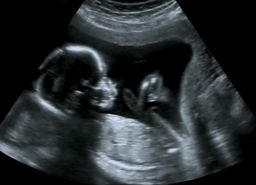  Ultrasound of fetus at fourth month of pregnancy.