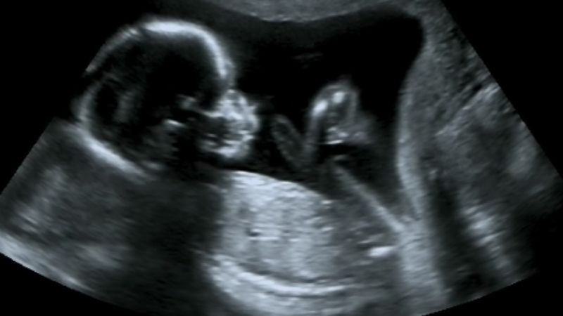 Ultrasounds use harmless high-frequency sound waves that reflect to give a ...