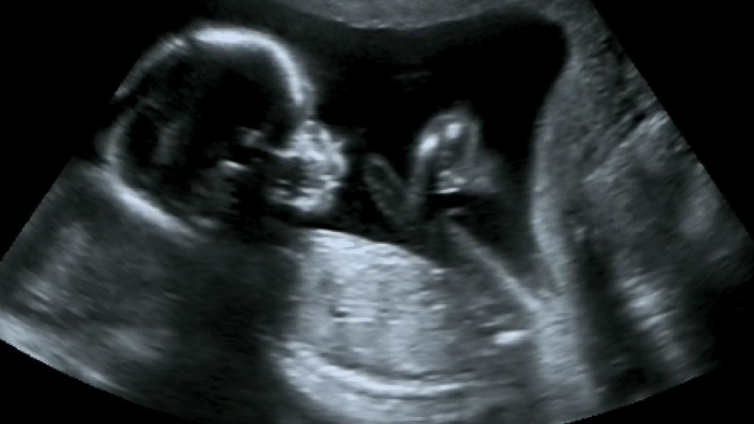 An obstetric ultrasound of a fetus at the fourth month.
