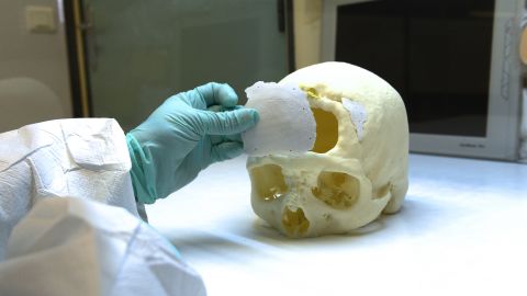 Nanostructured surfaces for implants are already becoming part of the medical firmament. "These are being approved by the Food and Drug Administration and we're seeing better bone growth, better tissue growth and we're seeing the ability to decrease infection using these materials," said Dr Thomas Webster.<br />