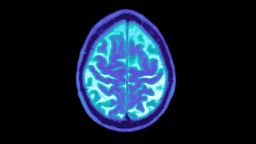 Alzheimer's brain 