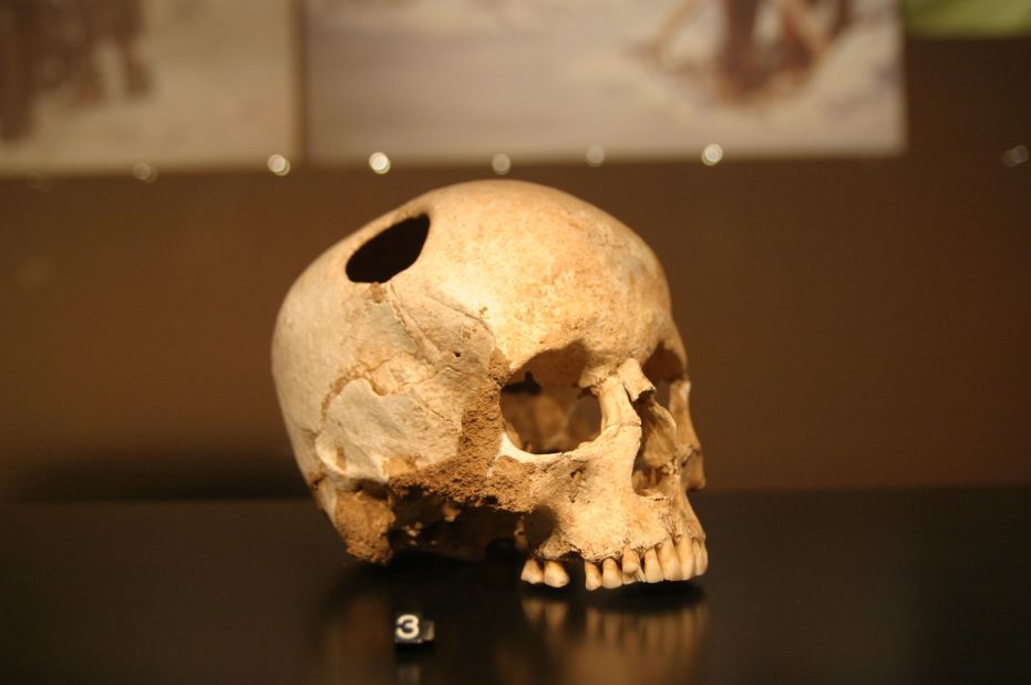 Trepanation -- the practice of cutting a hole in the skull -- was performed using obsidian tools by Neolithic cultures, although its purpose remains unknown. This skull in Lausanne Museum, in France, shows signs of bone regrowth, meaning the patient survived the operation.