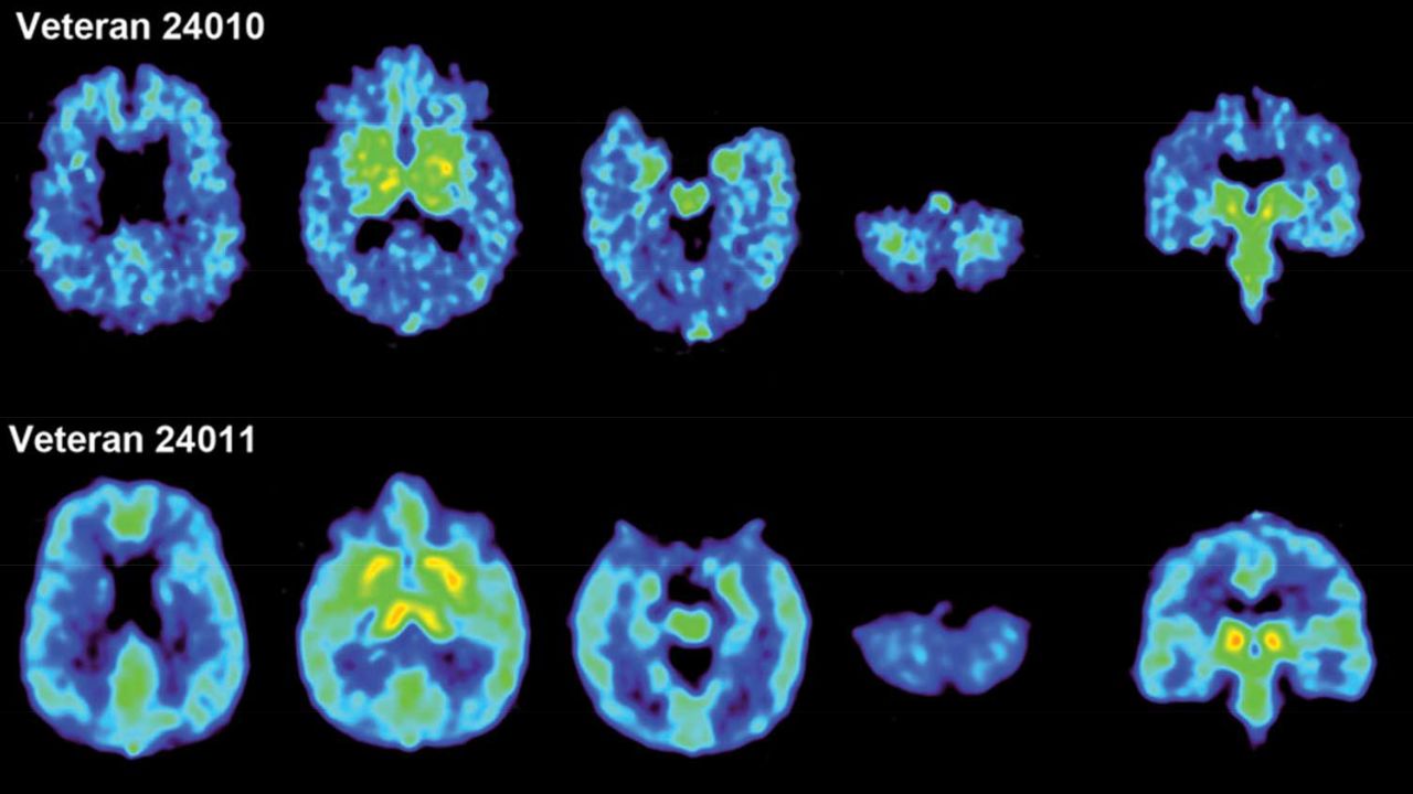 Living brain scans of Tommy Shoemaker and Shane Garcie