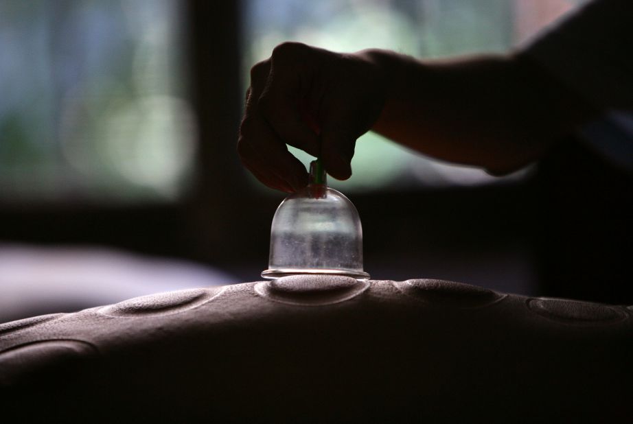 Cupping therapy has been practiced from as early as the 6th century, according to Totelin, and is seeing a comeback today through the increased popularity of traditional medicine. "Globalization of medicine is attracting Western people to this holistic practice," says Stein. <br /><br />The practice involves cups placed on specific regions of the body to create suction and encourage blood flow. Practitioners believe it promotes healing for a broad range of ailments in a similar way to the premise of bloodletting and leeching -- the goal being to balance levels of blood inside the body.<br /><br />"Cupping was more common," says Totelin about the treatment which is still practiced today in Chinese medicine. In ancient times, however, its use was part of everyday life. "Cupping is one of the big things you do ... to be healthy," adds Stein. "[People would] place a cup to draw blood out of the body or to prevent getting sick."