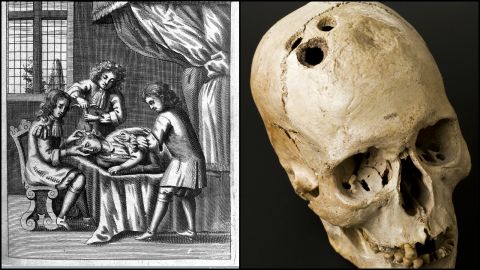 Dating back before ancient Roman and Greek times, according to Totelin, holes were drilled into human skulls to relieve a range of ailments from migraines to head injuries. <br /><br />The practice -- known as trepanation -- is considered by experts to be the oldest form of neurosurgery.  Its original use was to relieve pressure, reduce swelling and also enhance overall bloodflow in the brain and improve well-being.<br /><br />The premise behind the practice is still used by neurosurgeons today to reduce swelling and pressure in the brain before, or after, surgery.<br />