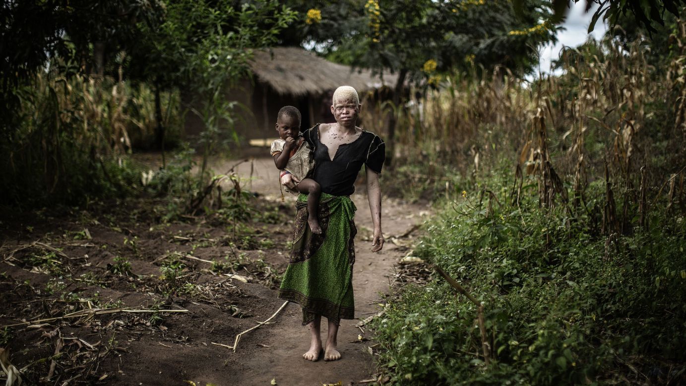 Mainasi Issa, a 23-year-old albino woman, carries her 2-year-old daughter, Djiamila Jafali, outside her hut in the Machinga district of Malawi on Friday, April 17. Six albinos have been killed in the African nation since December, according to the Association of Persons with Albinism in Malawi.
