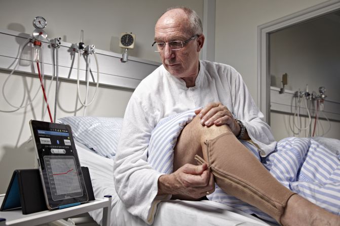 These socks, by Danish company Ohmatex, monitor edema. This is fluid retention commonly found in the feet and legs and is monitored by electronically measuring the circumference of the wearer's leg. The presence of fluid can be an early-warning sign of heart failure or pre-eclampsia. 