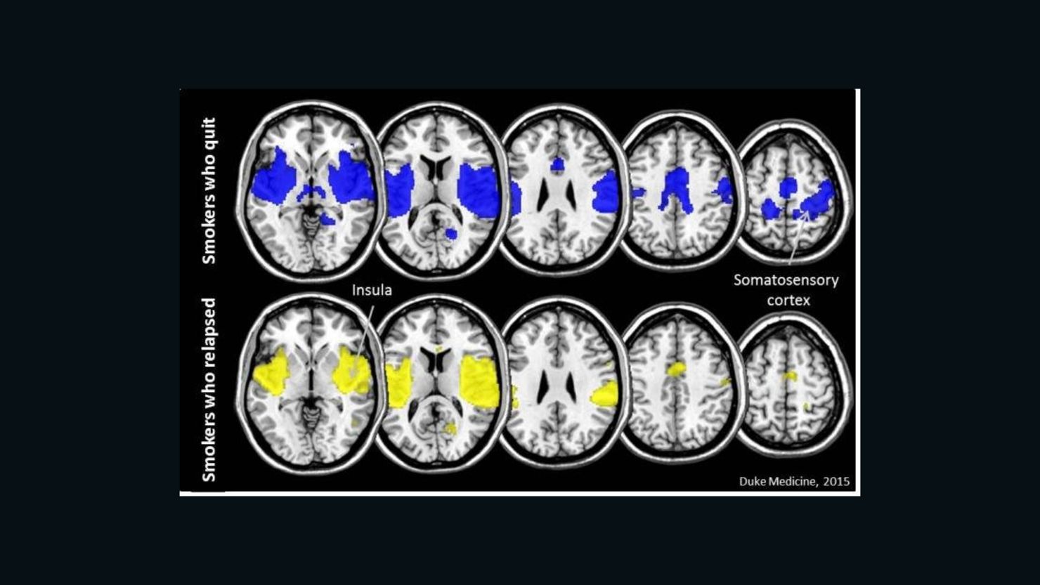 The brains of smokers who successfully quit have more connectivity in an area called the insula (in blue) than those of smokers who relapse (in yellow). 