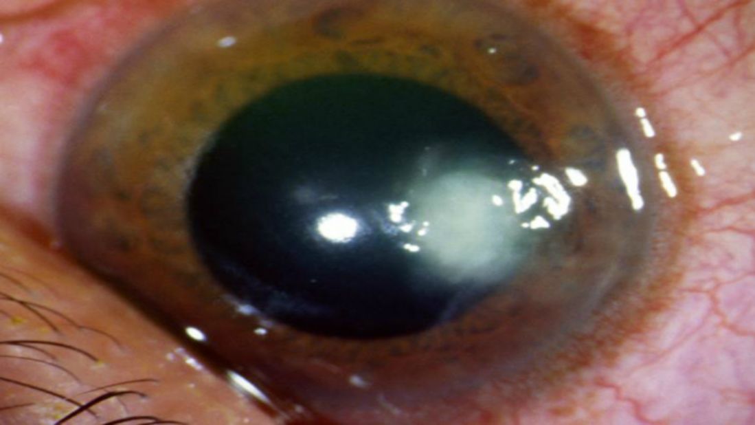 Many diseases of the cornea -- such as fungal ulcers -- are emergencies requiring immediate recognition and treatment.  Doctors need to diagnoses quickly to prevent long-lasting damage.