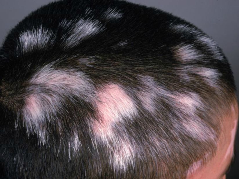 A case of vitiligo in which the body's immune system wrongly "attacks" melanocytes -- the pigment producing cells in the skin and hair follicle. 
