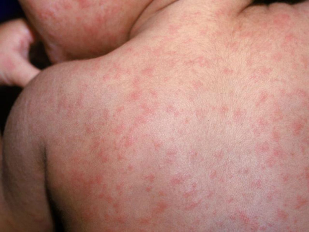 Most U.S. physicians practicing today have never diagnosed measles. The disease was been eradicated in the country in 2000, but cases can be imported from overseas. Pictured, measles in a child.