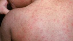 Most physicians practicing today have never diagnosed measles as the disease had been eradicated in the U.S. in 2000, but cases can be imported from other countries. Pictured, measles in a child.