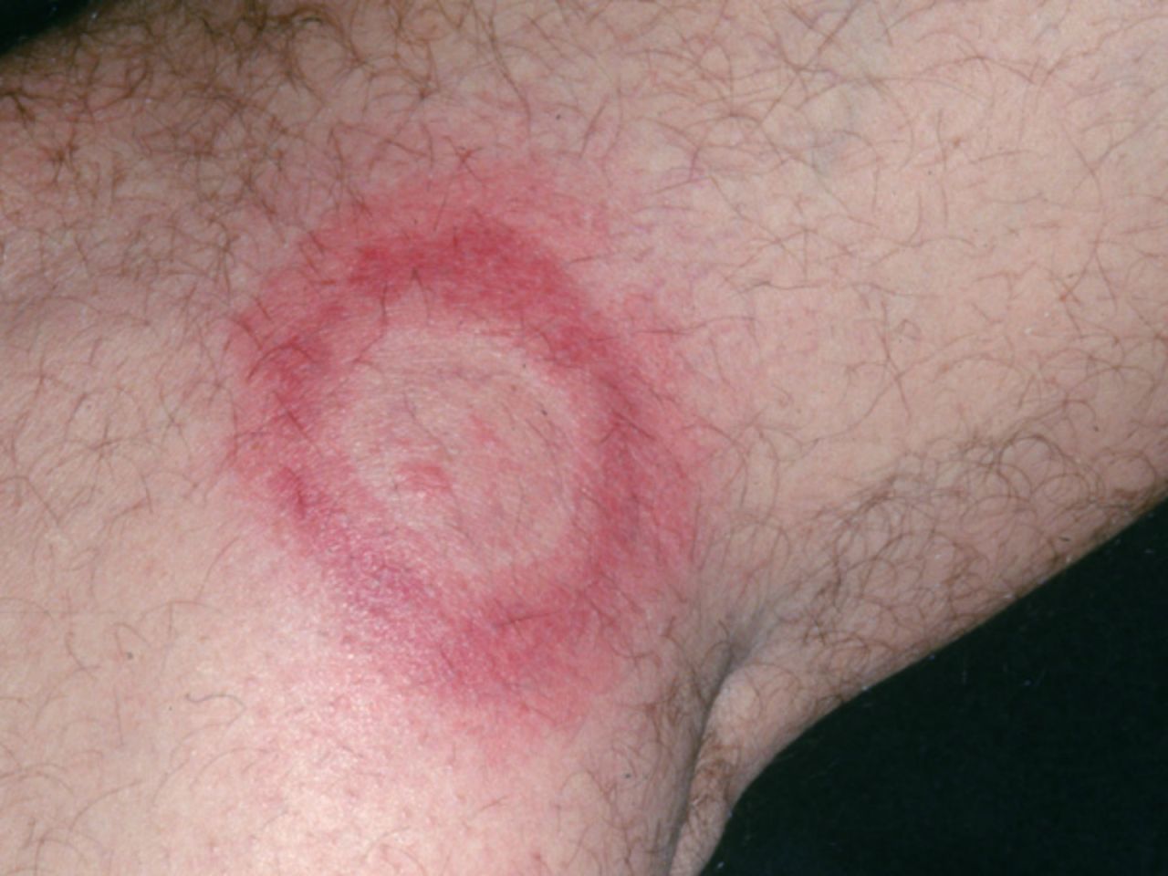The deer tick transmits Lyme disease -- common to the northeast and upper Midwest of the USA. Many patients first develop an expanding "bull's-eye-like" rash at the site of the tick bites. The rash can be compared and verified using VisualDx to ensure an accurate diagnosis.