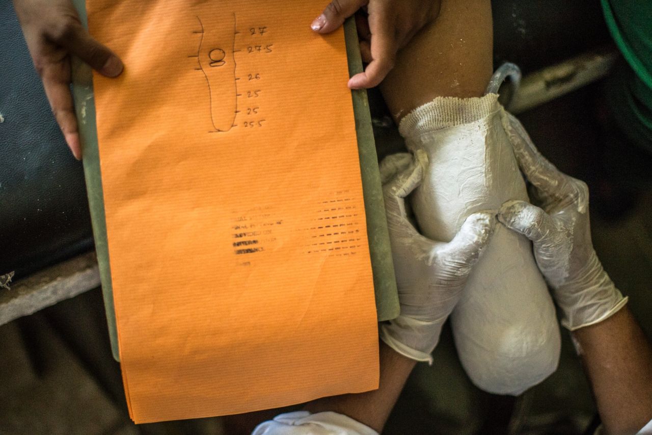Doctors carefully measure Maya's left limb to make her a prosthetic leg.
