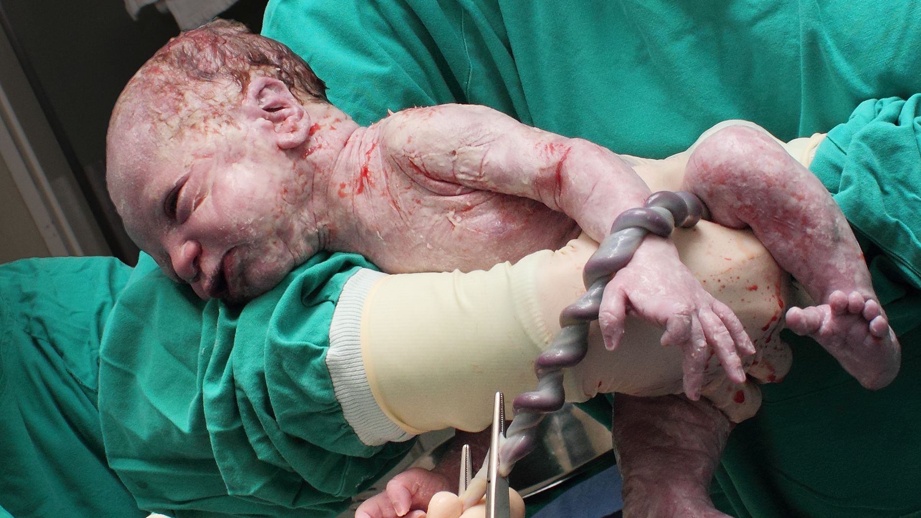 umbilical cord baby