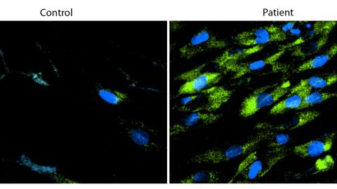 Cells from patients with Batten disease (right) have defects in their ability to clear waste products (green), and this waste builds up inside the cells. Cells from healthy family members (left) have lower levels of waste accumulation. The blue represents the nucleus in each cell.