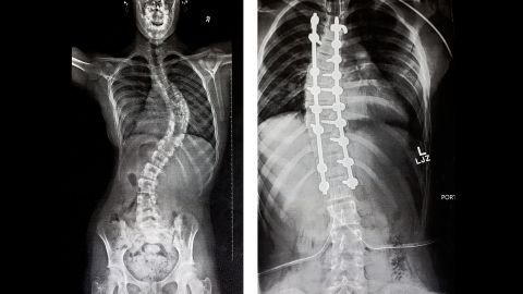A comparison of Hannah's X-rays before and after her surgery. Today, her back has healed beautifully and she's entering her first year of high school.