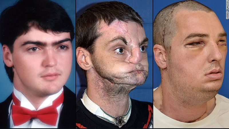 Facial discrimination Living with a disfigured face