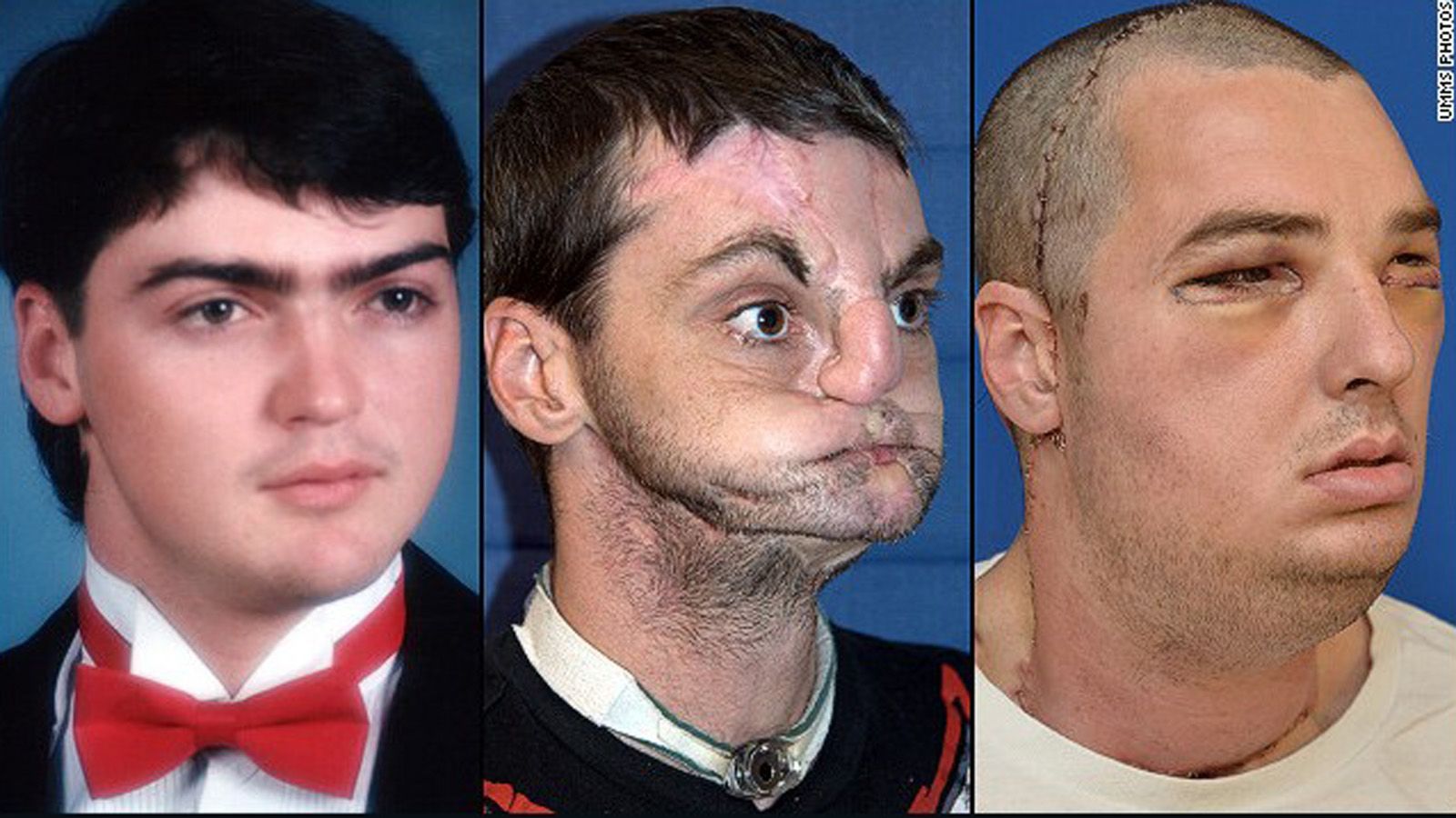 Facial discrimination: Living with a disfigured face
