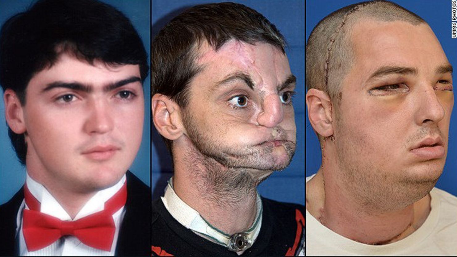 American Richard Norris: left, in high school in 1993; center, after suffering a gunshot injury; right, after face transplant surgery. 