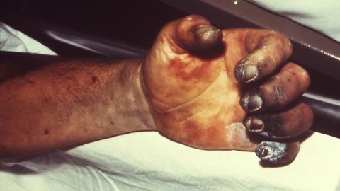 The bacterium that is responsible for the plague can sometimes infect the blood, causing the hands, feet, nose and lips to become gangrenous and black. This form of the disease is almost always fatal if not treated with antibiotics. 