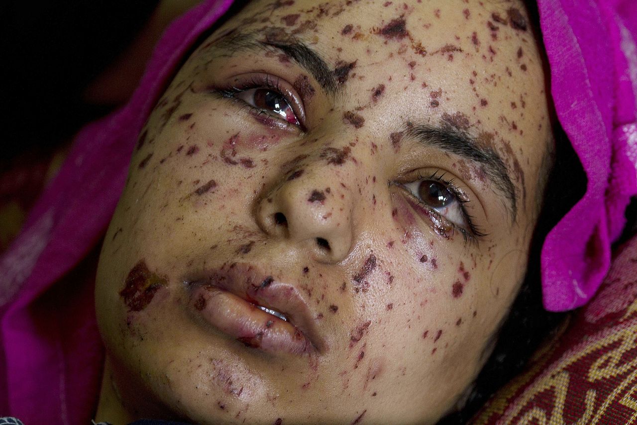 Rawya "was seriously injured during last summer's war when an Israeli air strike hit her family's apartment in Gaza City," Levine says.<br /><br />"I first photographed her at Shifa hospital; her face was wounded by shrapnel and her legs had perforated holes and were in a cast."<br /><br />"Her right hand was also seriously injured; all the bones and nerves crushed. Her aunt told me that at that time she still did not know that her four-year old sister and two aunts were killed."