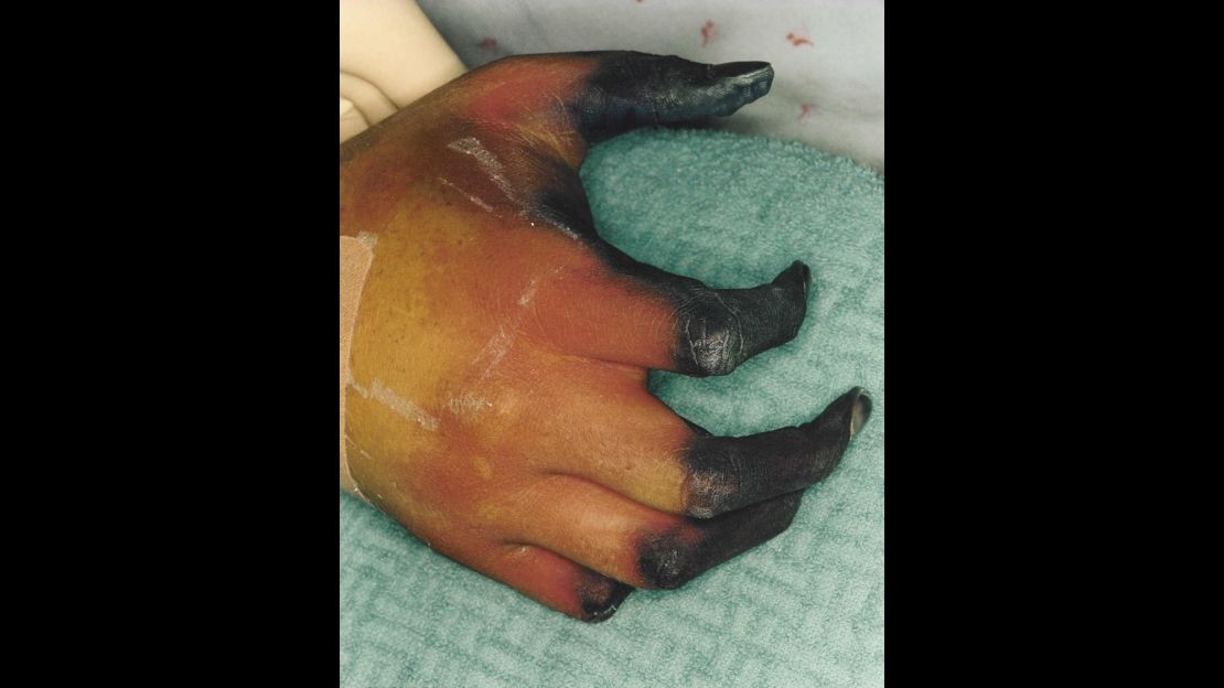 Evan Bozof's hand after getting meningitis.