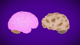 alzheimers brain