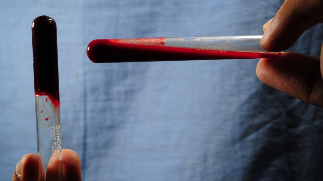 Viper venom prevents blood from clotting, which can be harnessed for anticoagulant drugs. Pictured, left: Blood from a healthy control coagulates after 20 minutes of test time. Right: Bitten by a mountain pit viper, blood from a patient in Nepal remains unclotted after 20 minutes.
