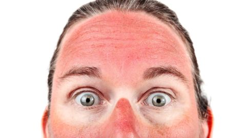 In the most severe cases of sunburn, people can develop blisters and need to be treated like burn victims.