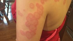 bed bugs kissimmee resort florida pkg _00001610.jpg