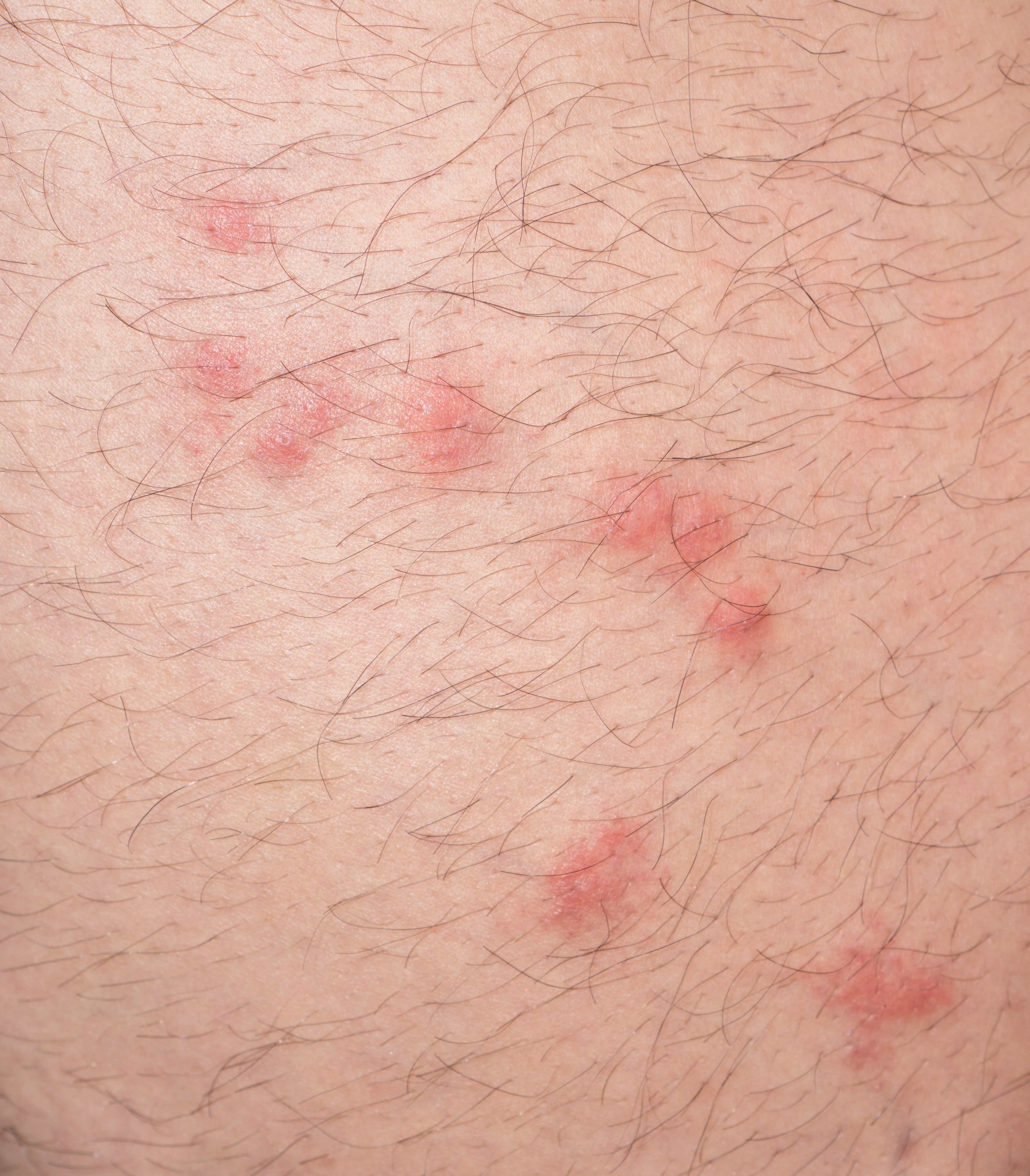 Rash That Looks Like Bug Bites And Itches