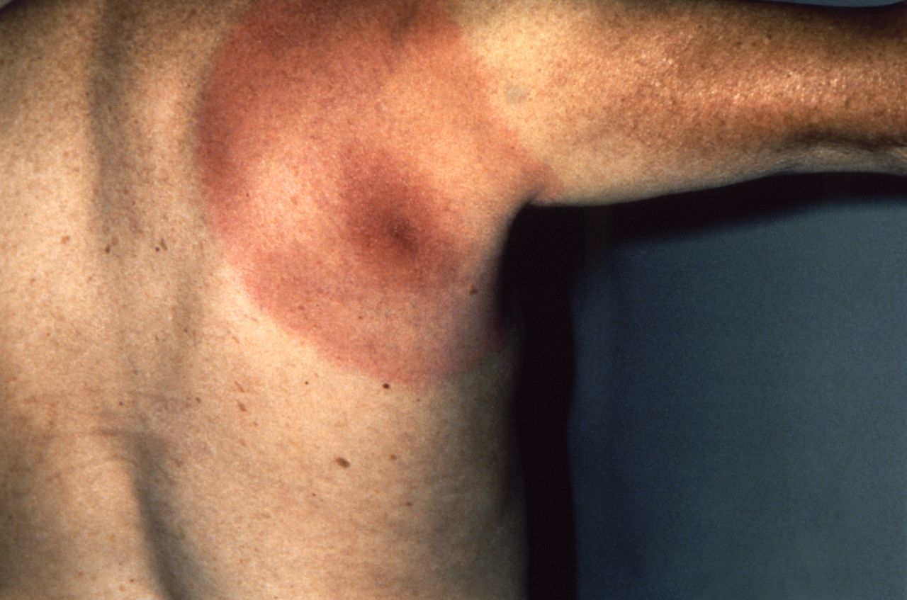 A tick bite's telltale bull's-eye rash.