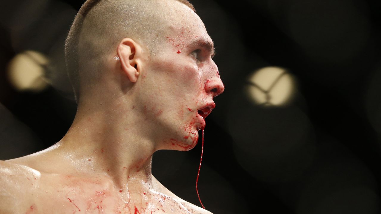 Blood drips from UFC fighter Rory MacDonald during his welterweight title bout against Robbie Lawler on Saturday, July 11. Lawler defended his title with a fifth-round stoppage.